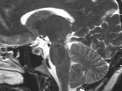 Resonancia magnética saxital del celebru d’un paciente con sintomatoloxía asemeyada a Chiari.
