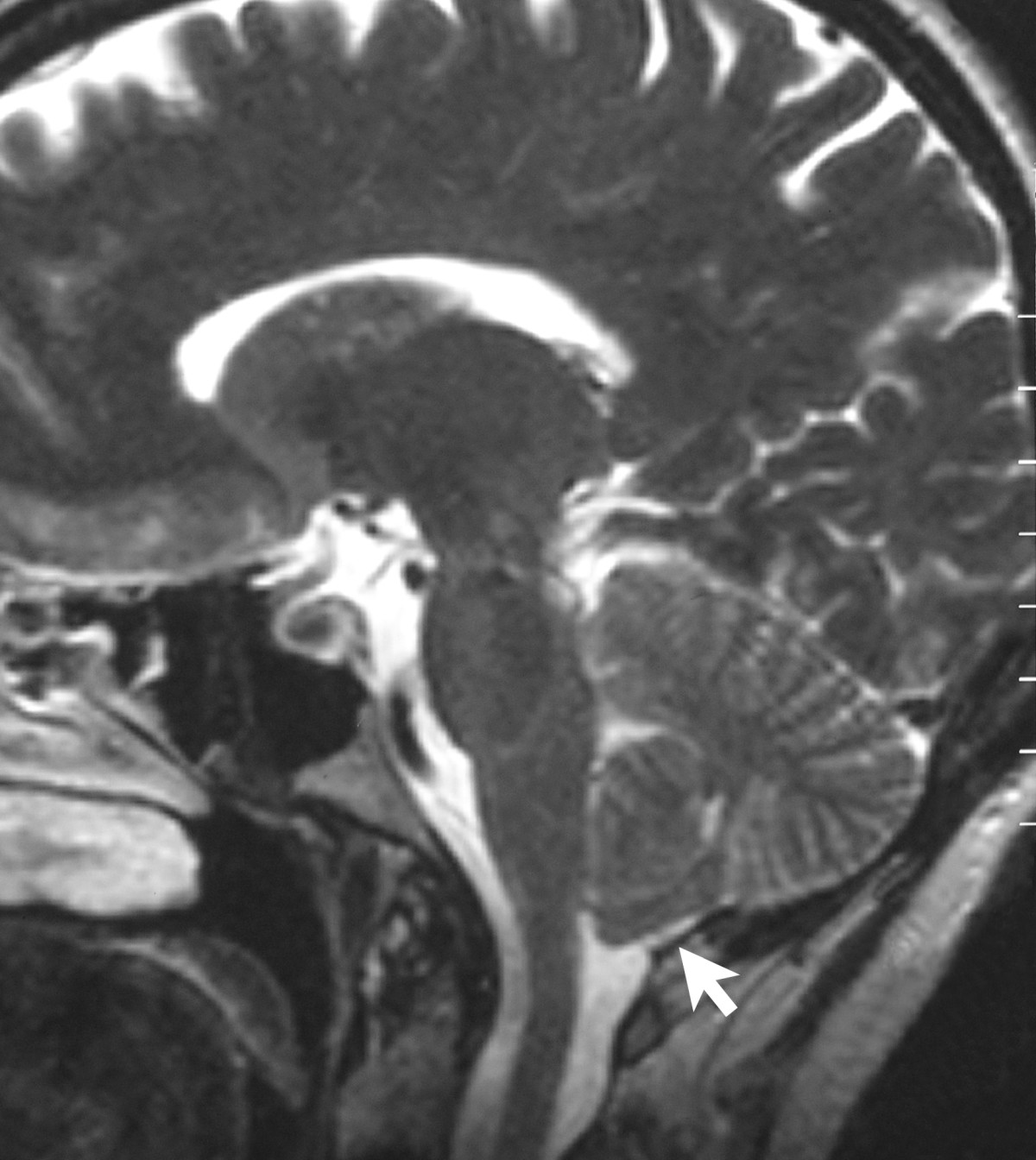 Resonancia magnética saxital del celebru d’un paciente con sintomatoloxía asemeyada a Chiari.